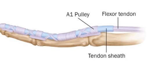 Diagram of a finger showing the A1 pulley, flexor tendon and tendon sheath