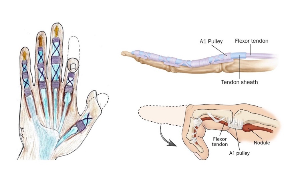 Diagrams of the hand and finger showing the flexor tendons, A1 pulleys and tendon sheath, and a nodule catching at the A1 pulley
