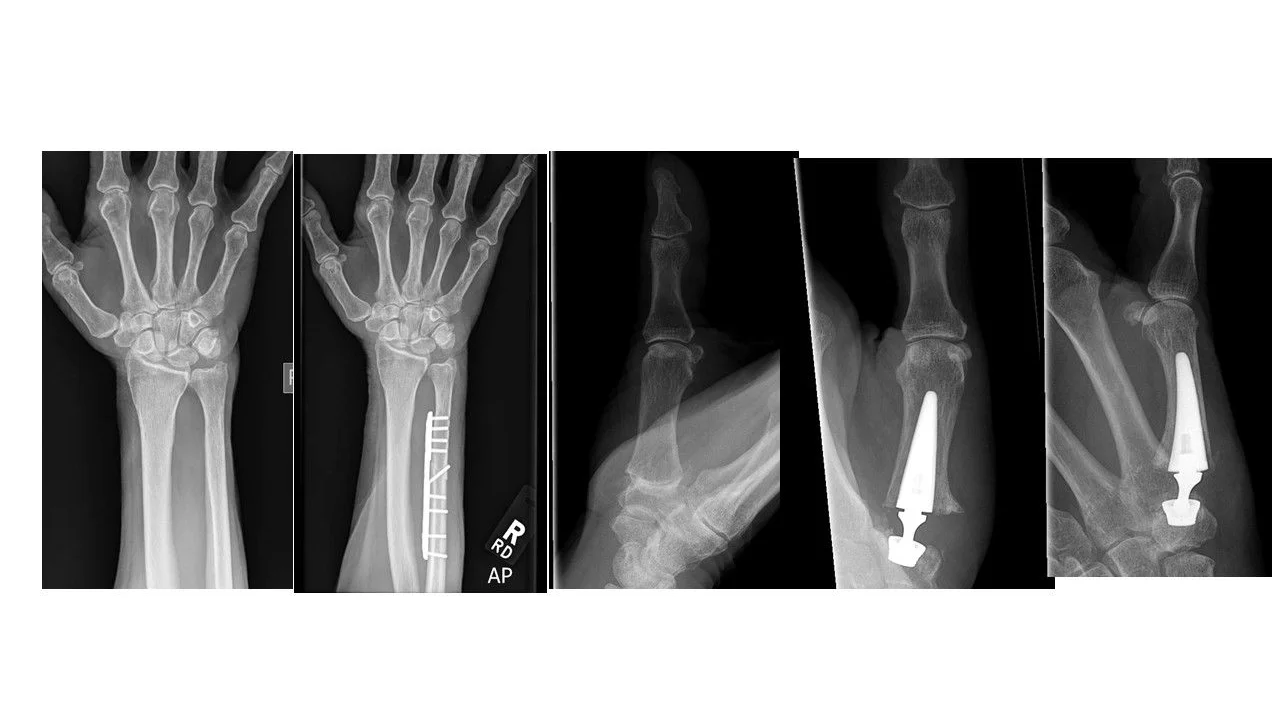 Hand & Wrist Surgery