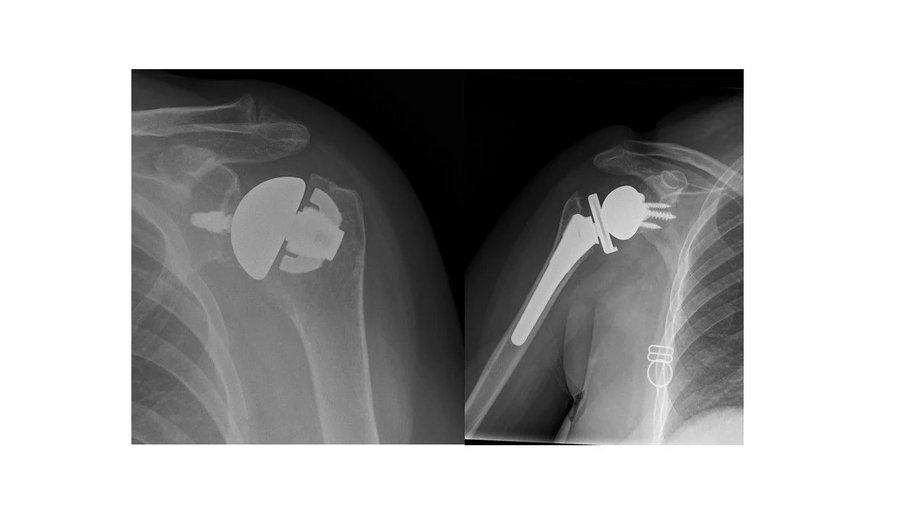 Shoulder Surgery