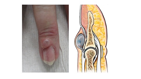 Mucus cyst photo and diagram to help explain the condition and treatment